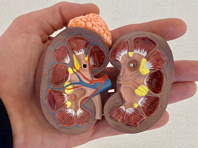Kidney transplant care